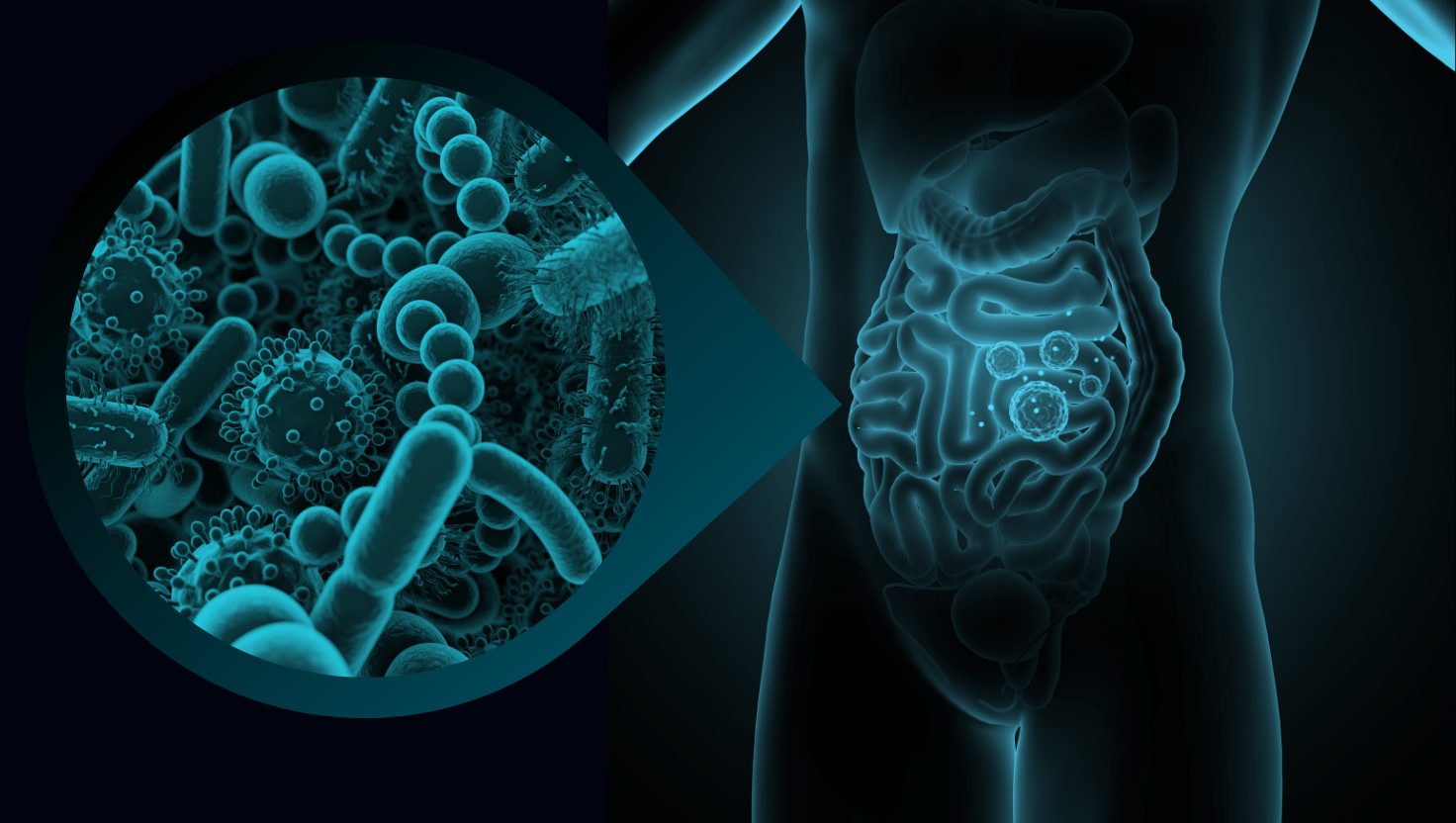 SIBO: When the Story Doesn’t Match the Symptoms